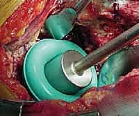 الخيارات العلاجية لمفصل الورك