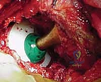 أسباب تلف مفصل الورك والتهاب المفاصل