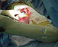 الدقة في تثبيت المفصل الصناعي