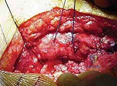 صورة توضيحية لـ استبدال مفصل الورك الكلي بالإسمنت: دليل شامل لمرضى الدكتور محمد هطيف في صنعاء