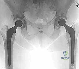 أعراض آلام مفصل الورك المتقدمة