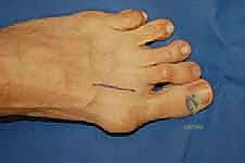 عملية شيفرون البعيدة: حل شامل لتصحيح إبهام القدم الأروح مع الأستاذ الدكتور محمد هطيف في صنعاء