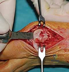 التقييم الشعاعي والسريري لتشوه إبهام القدم الأروح - صورة 1