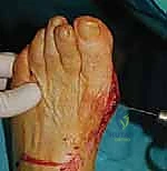 صورة توضيحية لـ عملية شيفرون البعيدة: حل شامل لتصحيح إبهام القدم الأروح مع الأستاذ الدكتور محمد هطيف في صنعاء