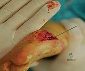 العلاجات التحفظية والأجهزة التقويمية لتخفيف ألم إبهام القدم الأروح