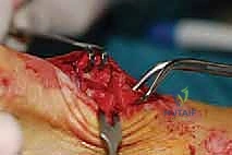 صورة توضيحية لـ عملية شيفرون البعيدة: حل شامل لتصحيح إبهام القدم الأروح مع الأستاذ الدكتور محمد هطيف في صنعاء