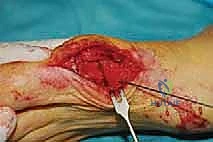 صورة توضيحية لـ عملية شيفرون البعيدة: حل شامل لتصحيح إبهام القدم الأروح مع الأستاذ الدكتور محمد هطيف في صنعاء