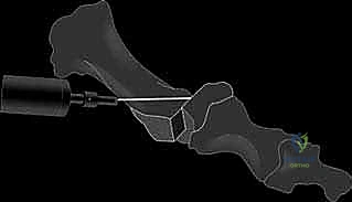 صورة طبية: عملية شيفرون البعيدة: حل شامل لتصحيح إبهام القدم الأروح مع الأستاذ الدكتور محمد هطيف في صنعاء