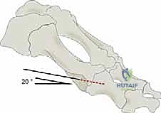 صورة توضيحية لـ عملية شيفرون البعيدة: حل شامل لتصحيح إبهام القدم الأروح مع الأستاذ الدكتور محمد هطيف في صنعاء
