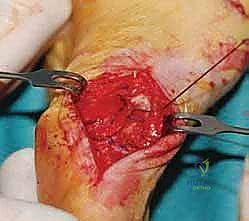 صورة طبية: عملية شيفرون البعيدة: حل شامل لتصحيح إبهام القدم الأروح مع الأستاذ الدكتور محمد هطيف في صنعاء