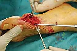 صورة طبية: عملية شيفرون البعيدة: حل شامل لتصحيح إبهام القدم الأروح مع الأستاذ الدكتور محمد هطيف في صنعاء