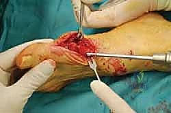 صورة طبية: عملية شيفرون البعيدة: حل شامل لتصحيح إبهام القدم الأروح مع الأستاذ الدكتور محمد هطيف في صنعاء