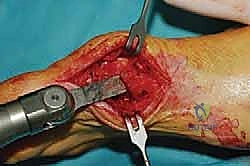 صورة طبية: عملية شيفرون البعيدة: حل شامل لتصحيح إبهام القدم الأروح مع الأستاذ الدكتور محمد هطيف في صنعاء