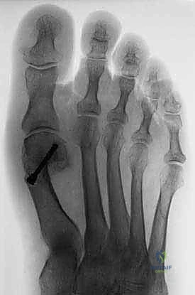 صورة طبية: عملية شيفرون البعيدة: حل شامل لتصحيح إبهام القدم الأروح مع الأستاذ الدكتور محمد هطيف في صنعاء