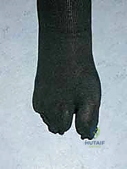 صورة طبية: عملية شيفرون البعيدة: حل شامل لتصحيح إبهام القدم الأروح مع الأستاذ الدكتور محمد هطيف في صنعاء