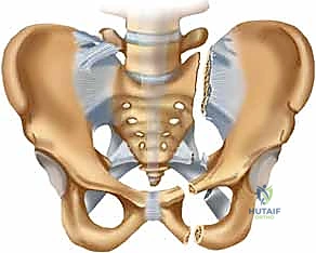 أهمية التدخل الجراحي السريع في كسور الحوض