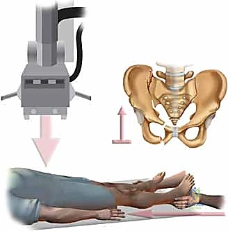 آليات الإصابة بكسور الحوض