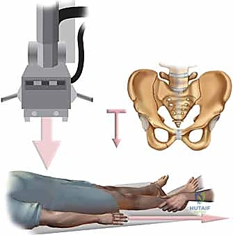 حوادث السير كسبب رئيسي لكسور الحوض