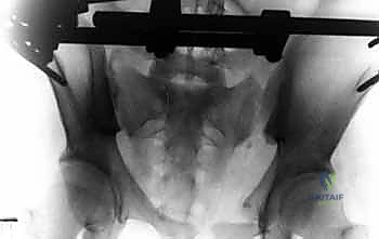 إدخال المسامير المعدنية في عظام الحوض