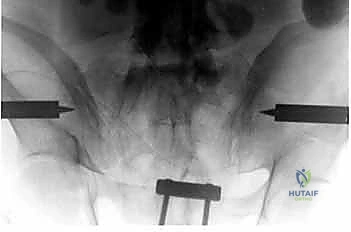 تصنيف كسور الحوض حسب درجة الاستقرار