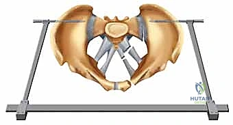 تورم وكدمات ناتجة عن كسر الحوض