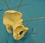الكسور غير المستقرة وتأثيرها على الحوض