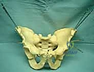 استخدام الأشعة المقطعية ثلاثية الأبعاد في تشخيص الحوض