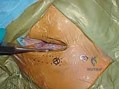 أعراض وعلامات كسر الحوض السريرية