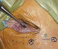 التخطيط الجراحي قبل عملية التثبيت الخارجي