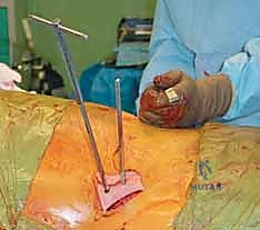 مقارنة بين التثبيت الداخلي والخارجي