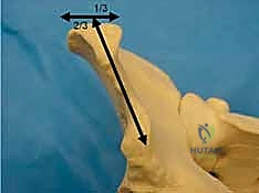 أدوات التثبيت الخارجي الحديثة