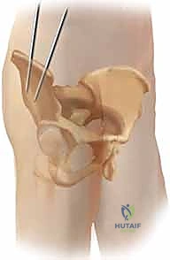 التجهيز لعملية التثبيت الخارجي