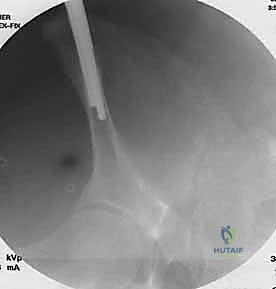 صورة توضيحية لـ التثبيت الخارجي للحوض: دليل شامل للمرضى مع الأستاذ الدكتور محمد هطيف في صنعاء