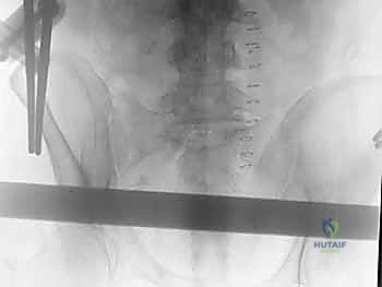 صورة طبية: التثبيت الخارجي للحوض: دليل شامل للمرضى مع الأستاذ الدكتور محمد هطيف في صنعاء