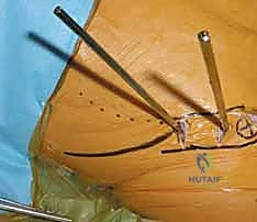 صورة توضيحية لـ التثبيت الخارجي للحوض: دليل شامل للمرضى مع الأستاذ الدكتور محمد هطيف في صنعاء