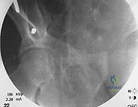 الرد والتثبيت النهائي للكسر