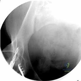 الشكل النهائي للمثبت الخارجي على المريض