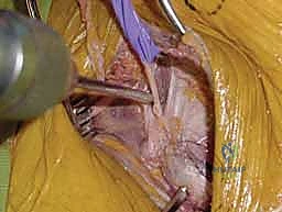 صورة طبية: التثبيت الخارجي للحوض: دليل شامل للمرضى مع الأستاذ الدكتور محمد هطيف في صنعاء