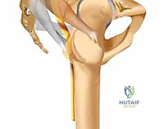 صورة طبية: التثبيت الخارجي للحوض: دليل شامل للمرضى مع الأستاذ الدكتور محمد هطيف في صنعاء