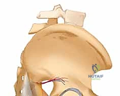 صورة توضيحية لـ التثبيت الخارجي للحوض: دليل شامل للمرضى مع الأستاذ الدكتور محمد هطيف في صنعاء