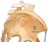 صورة توضيحية لـ التثبيت الخارجي للحوض: دليل شامل للمرضى مع الأستاذ الدكتور محمد هطيف في صنعاء