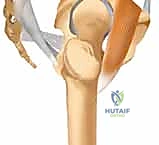 صورة طبية: التثبيت الخارجي للحوض: دليل شامل للمرضى مع الأستاذ الدكتور محمد هطيف في صنعاء