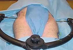 صورة توضيحية لـ التثبيت الخارجي للحوض: دليل شامل للمرضى مع الأستاذ الدكتور محمد هطيف في صنعاء