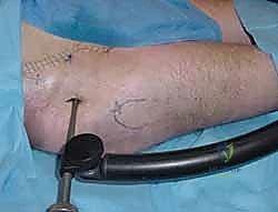 Illustration of fixation of the pelvis - Dr. Mohammed Hutaif