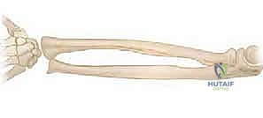 صورة توضيحية لـ كسور عظمي الساعد عند الأطفال: العلاج المتقدم بالمسامير المرنة داخل النخاع مع الأستاذ الدكتور محمد هطيف