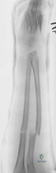 القوى العضلية وتأثيرها على كسور الساعد