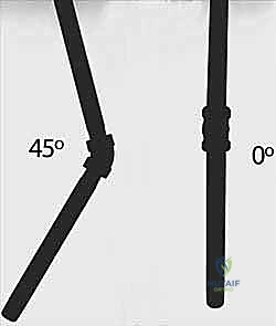 صورة أشعة سينية توضح كسراً كاملاً في عظمي الساعد