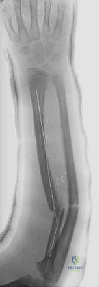 تشريح عظام الساعد والانحناء الطبيعي للكعبرة