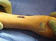 تجهيز المسامير المرنة قبل الجراحة