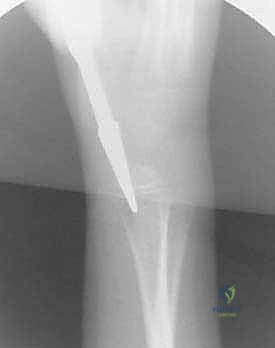 فتح القناة النخاعية بأداة جراحية دقيقة